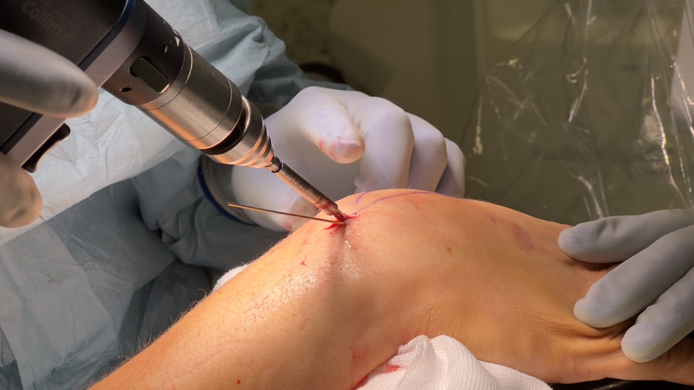 Fijación percutánea del escafoides mediante una pequeña incisión, con instrumental de precisión y control radiológico intraoperatorio.