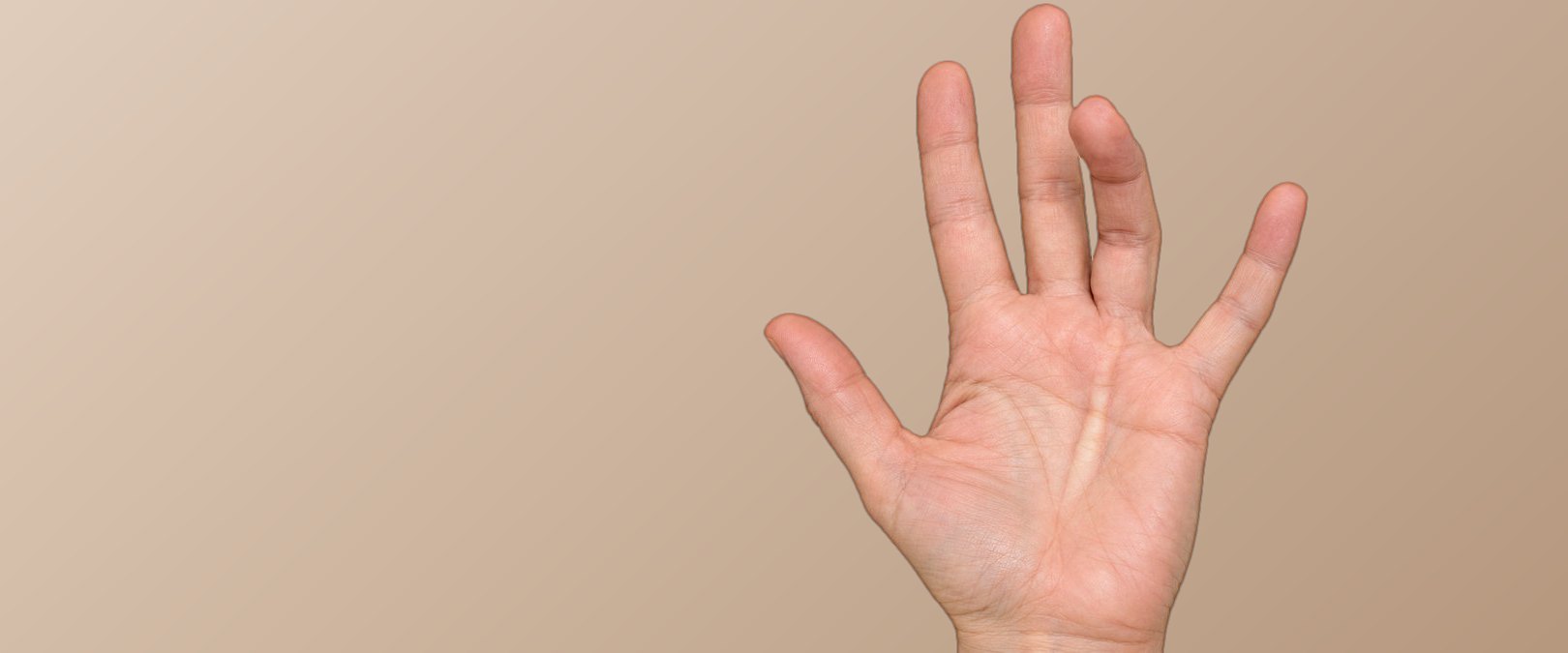 Mano abierta con una cuerda de Dupuytren en la palma que mantiene doblado el dedo anular